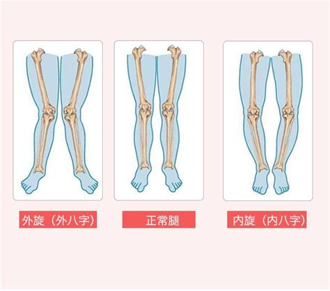 外八字腳|外八字腳的矯正方法 :: MedTexts 百科醫典